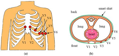 Placement Of Electrodes With Unipolar Precordial Leads