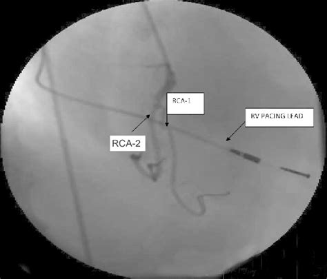 A Right Anterior Oblique View Demonstrating Double Right Coronary