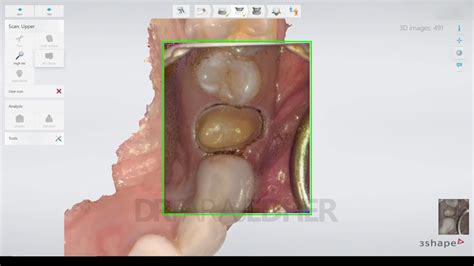 intra oral scanning for a single crown prep trios 3shape youtube