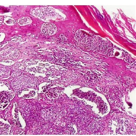 Malignant Melanoma With Pagetoid Distribution Of Melanoma Cells And