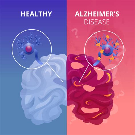 Alzheimers Disease The Basics Alzheimers Los Angeles