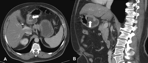 The Role Of Computed Tomography In The Imaging Of Gastric Carcinoma