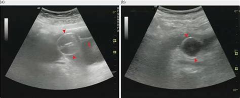Bladder Ultrasound For Catheterization And Suprapubic Aspiration