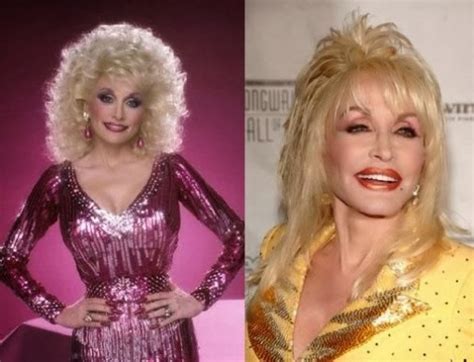 Dolly Parton Plastic Surgery Before And After Breast Implants Botox