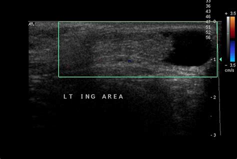 The indirect occur at any age, from infancy to the elderly. Indirect inguinal hernia | Image | Radiopaedia.org