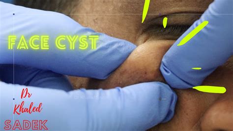 Face Cyst Removal Dr Khaled Sadek LipomaCyst Com YouTube