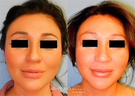 Dermal Fillers Before and After Pictures Case 157 | Las Vegas and