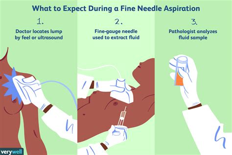 Fine Needle Aspiration For Breast Biopsy Uses Side Effects Procedure