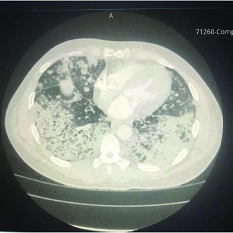 Ct Scan Of The Chest Showing Extensive Bilateral Parenchymal