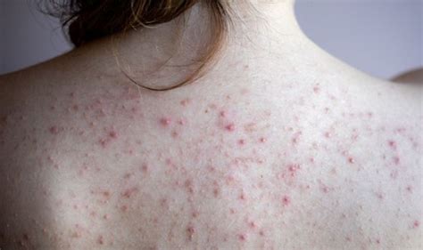 Spots On Your Back The 4 Interesting Causes Of A Spotty Back Express