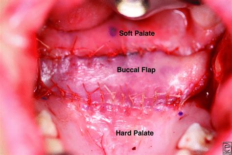 Palatal Lengthening With Double Opposing Buccal Flaps For