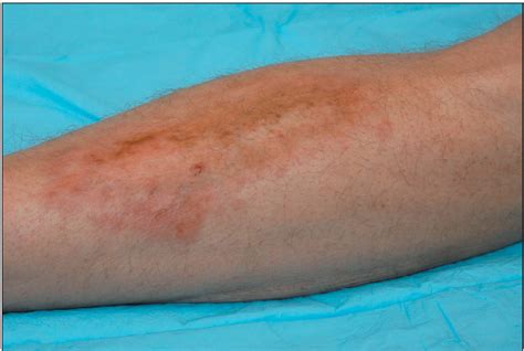 Acute Dx Persistent Rash In A Man With Diabetes Consultant