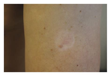 Halo Nevus On The Left Upper Arm The Central Part Shows Only A Light