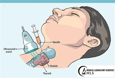 Fine Needle Aspiration Fna Biopsy Purpose Procedure Uses