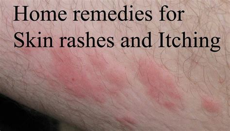Skin Rash Remedies Home Remedies For Rashes Natural H