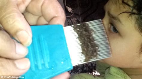 Head Lice Infestation Video Will Certainly Make Your Skin Crawl Daily