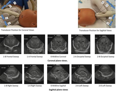 Ultrasound In The Neonatal Intensive Care Unit Radiology Key