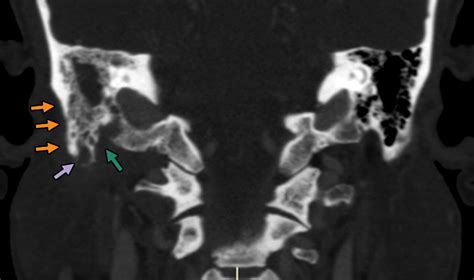 Diagnosis Of Skull Base Osteomyelitis Radiographics