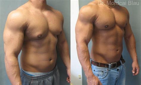 Bodybuilder Gynecomastia Before And After Photos ⋆ Gynecomastia Usa