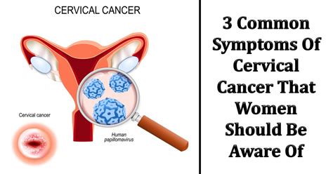 Cervical Cancer Symptoms How Uterine And Vaginal Differ Whattolaugh