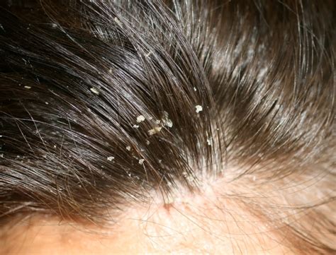 Fms Skin And Hair Best Dandruff Treatment In Hyderabad India