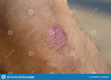 Ring Worm Infection Dermatophytosis On Skin Ringworm Infection Or