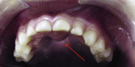 Nonodontogenic Cysts Dental Clinics