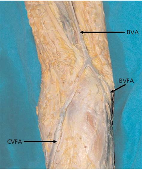 The Appearance Of Cephalic Vein Of The Forearm Was Found At Atypical