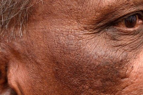 Slideshow Skin Problems Linked To Diabetes In 2020 Skin Problems
