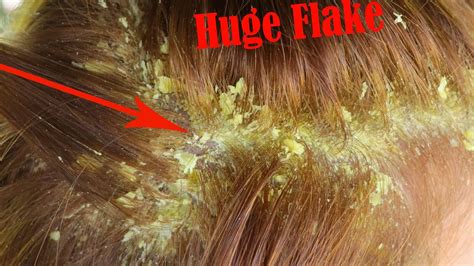Itchy Dry Scalp Scratching Dandruff Big Flakes On Back Of Head