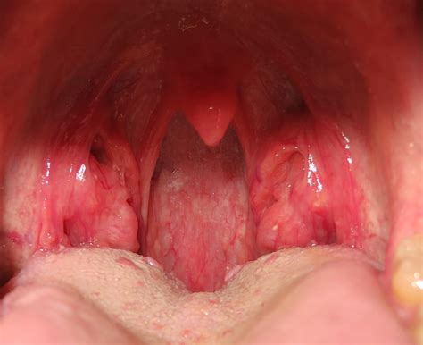 White Patches On Posterior Wall Of Oropharynx Ear Nose And Throat