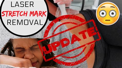 Laser Stretch Mark Removal Update 1 Youtube