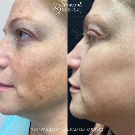 Remove Age Spots And Broken Capillaries With Ipl Therapy