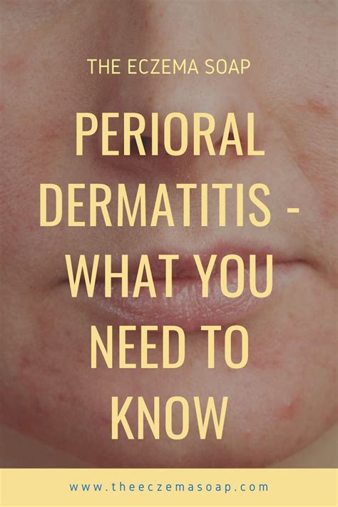 Perioral Dermatitis Symptoms Causes And Treatments Prof Dr Dirschka