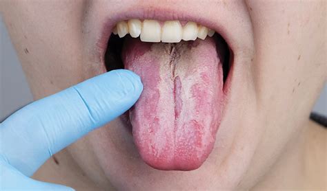 racgp common benign and malignant oral mucosal disease