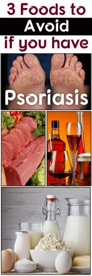3 Foods To Avoid If You Have Psoriasis