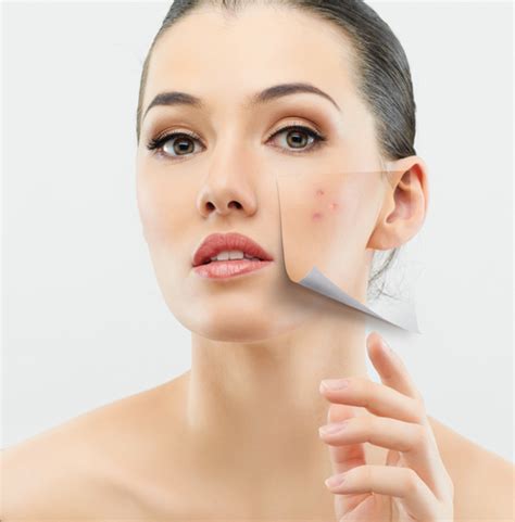 The Truth About Acne Is It Contagious Or A Result Of Our Genes