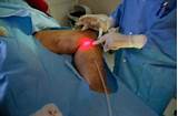 Endovenous Laser Treatment Images