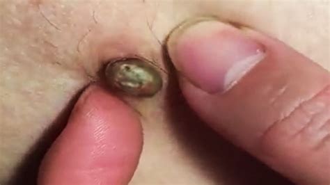 Epidermal Cyst Popping In The Ear Lobe Viral On The Web Now