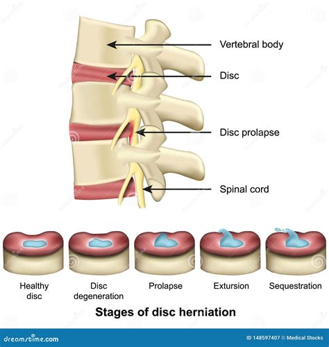 Stages Of Disc Herniation Spine And Disc Anatomy 3d Medical Vector
