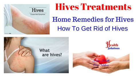 How To Treat Hives Hives Treatments Home Remedies For Hives Youtube