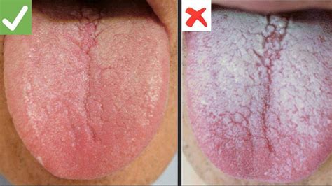 Health Appearance Of White Tongue Can Be A Sign Of Deficiency Of This Vitamin