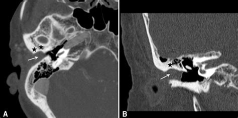 Enhanced Axial A And Coronal B Temporal Bone Ct Scan Shows An About