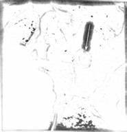 Полип сигмовидной кишки диета Клинические проявления, Диагностика (принципы и этапы постановки Клинические проявления, Диагностика (принципы и этапы постановки Полип сигмовидной кишки диета