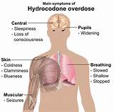 Marijuana Overdose Symptoms