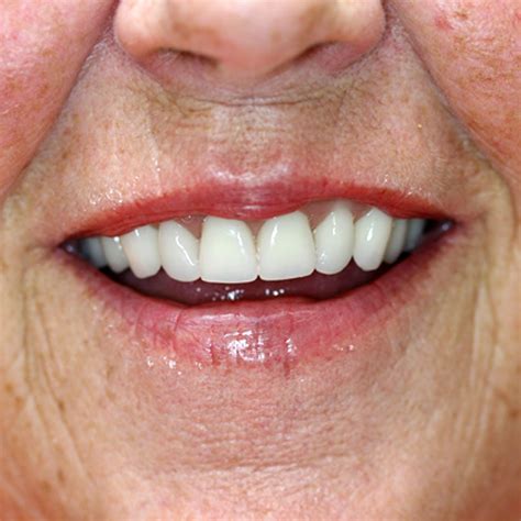 Cosmetic Dentures Natural Looking Dentures