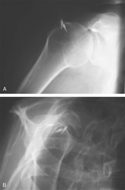 Evaluation And Management Of Failed Rotator Cuff Surgery