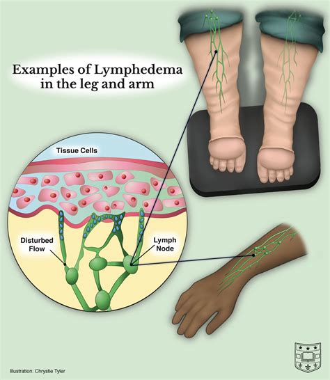 Ask The Doctors Lymphedema Symptoms And Causes With Doctors Sacks And Anolik Department Of