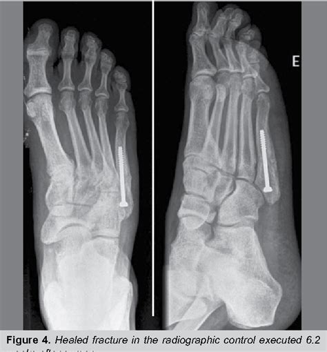 Figure 4 From Intramedullary Screw Fixation Of Proximal Fifth Metatarsal Fractures In Athletes