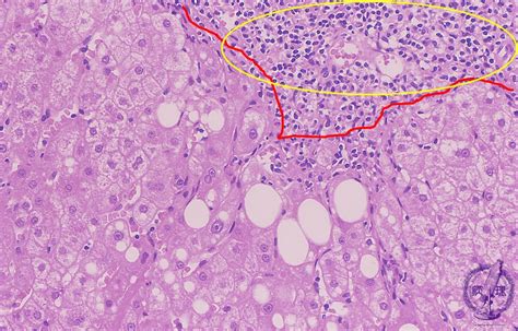 10liver 1 Chronic Viral Hepatitispathology Core Pictures